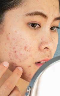7 hábitos que pioram a acne