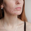 Utilizar algum produto sem consultar um dermatologista pode piorar o problema - iStock
