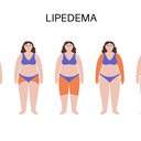 Existem diferentes tipos e graus de lipedema - iStock