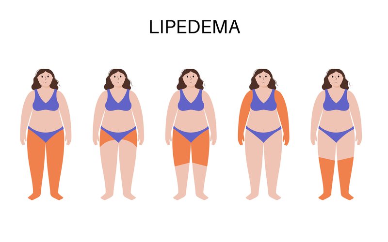 Existem diferentes tipos e graus de lipedema - iStock