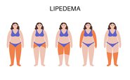 Existem diferentes tipos e graus de lipedema - iStock