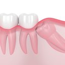 Uma dúvida muito comum é se os dentes do siso “empurram” os demais ao erupcionar - iStock