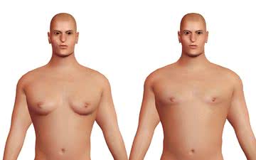 O procedimento mais procurado por meninos é devido ao crescimento da glândula mamária, a ginecomastia - iStock