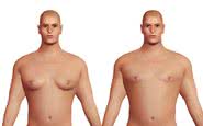 O procedimento mais procurado por meninos é devido ao crescimento da glândula mamária, a ginecomastia - iStock
