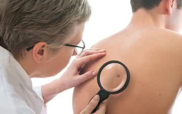 Câncer da pele é um exemplo dos problemas de saúde mais prevalentes entre a população masculina - iStock