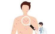 Embora o contato direto seja a forma mais comum de propagação da varíola, não é a única - iStock