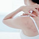 A pele sensível pode ficar vermelha, seca, arder, coçar ou tensionar, ou ainda ter inchaços, escamas ou urticária - iStock