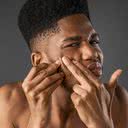 A acne é uma condição prevalente na adolescência capaz de afetar também o psicológico - iStock