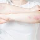 Saiba como cuidar da psoríase - iStock