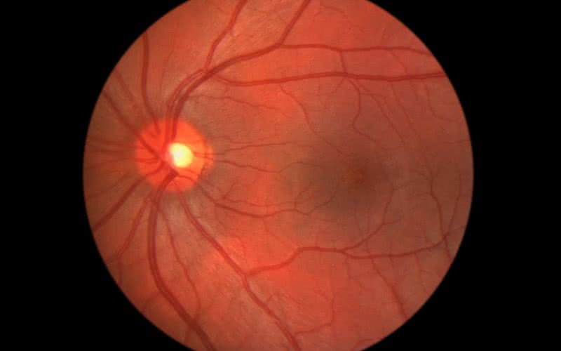 A presença dessas partículas virais reforça possíveis manifestações clínicas oculares da infecção - iStock