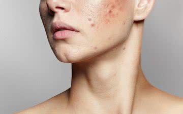 Fatores genéticos, questões hormonais e alimentação podem levar ao surgimento da acne em qualquer idade - iStock