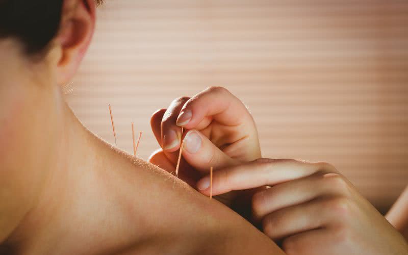 A acupuntura estimula áreas ricas em nervos através de agulhas para estimular várias funções do corpo - iStock