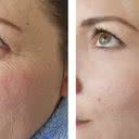 Simulação de antes e depois mostra como manchas de sol e bolsas embaixo dos olhos afetam a aparência - iStock