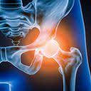 Na artrose, a inflamação ocorre pelo desgaste na cartilagem, que provoca atrito na articulação - iStock