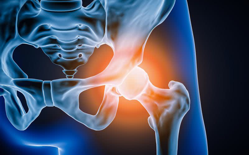 Na artrose, a inflamação ocorre pelo desgaste na cartilagem, que provoca atrito na articulação - iStock