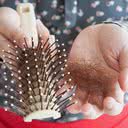 As causas da calvície em mulheres ainda não são totalmente conhecidas, mas há fatores de risco - iStock