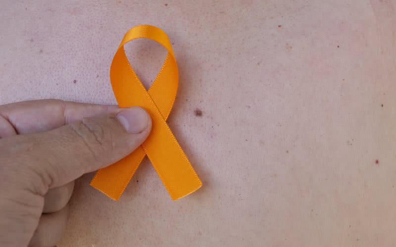 O câncer de pele não melanoma é o mais frequente no Brasil e corresponde a cerca de 30% dos tumores registrados - iStock