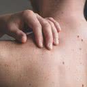 Feridas que não cicatrizam ou “pintas” que mudam de tamanho ou cor, doem ou coçam devem ser examinadas - iStock