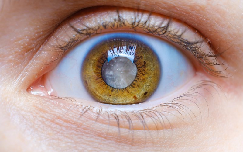 Médicos têm observado um aumento dos casos de catarata em pessoas mais jovens - iStock