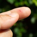 Será que é possível contrair o HIV só com um machucado? - iStock