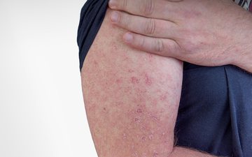 A erisipela é uma infecção da pele - iStock
