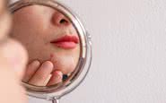 Em geral, a acne da idade adulta surge por desequilíbrios hormonais, estresse e alimentação - iStock