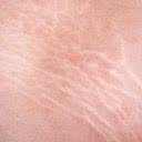 As estrias são cicatrizes provocadas pelo rápido estiramento da pele - iStock