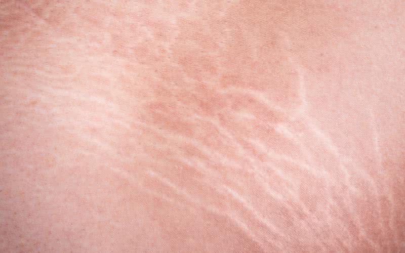 As estrias são cicatrizes provocadas pelo rápido estiramento da pele - iStock