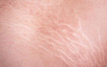 As estrias são cicatrizes provocadas pelo rápido estiramento da pele - iStock