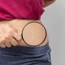 As estrias são cicatrizes provocadas pelo rápido estiramento da pele - iStock