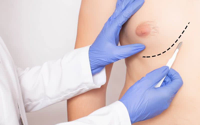 O aumento do tecido mamário no homem pode ser corrigido com cirurgia - iStock