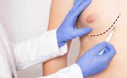 O aumento do tecido mamário no homem pode ser corrigido com cirurgia - iStock
