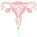 A inseminação intrauterina (foto) é um tratamento de baixa complexidade, ao contrário da fertilização in vitro - iStock