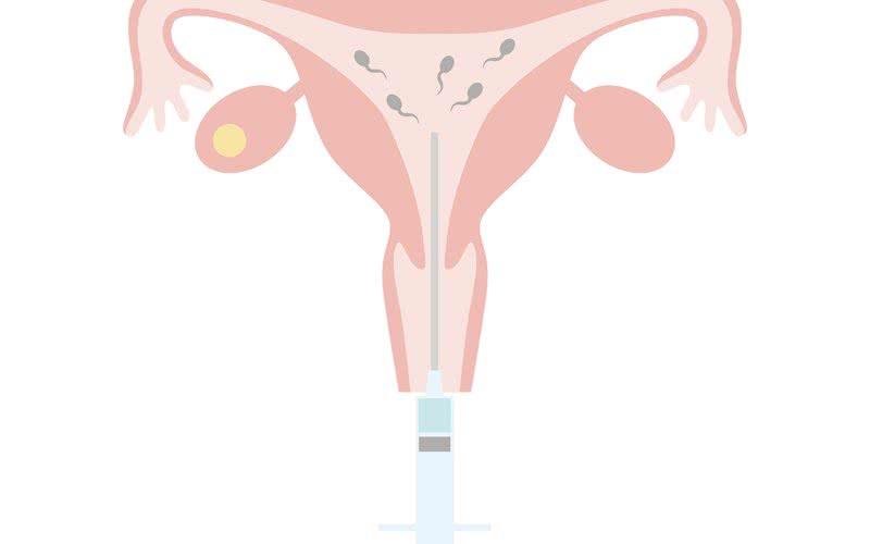 A inseminação intrauterina (foto) é um tratamento de baixa complexidade, ao contrário da fertilização in vitro - iStock