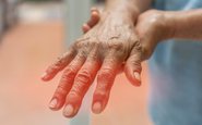 Formigamento ou dor nas mãos ou nos pés podem indicar danos aos nervos causados pelo diabetes - iStock