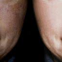 O melasma surge pela elevação dos níveis de hormônios femininos no organismo e pela exposição à luz - iStock