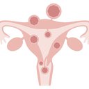 Para muitas mulheres, os miomas uterinos afetam bastante a qualidade de vida - iStock