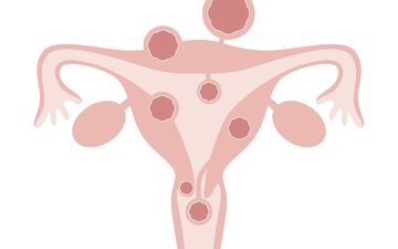 Para muitas mulheres, os miomas uterinos afetam bastante a qualidade de vida - iStock