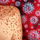 Os principais sintomas são febre, dores no corpo, cansaço e lesões bolhosas que evoluem para feridas dolorosas - iStock