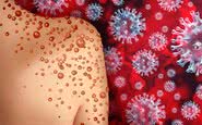 Os principais sintomas são febre, dores no corpo, cansaço e lesões bolhosas que evoluem para feridas dolorosas - iStock