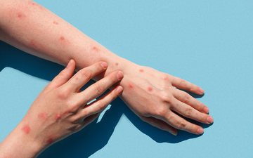 O sintoma mais característico da doença são lesões na pele - iStock