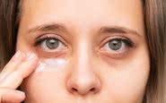 O tratamento das olheiras irá depender do tipo, por isso, é importante consultar um dermatologista - iStock