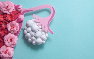 Os pequenos cistos no ovário geram uma liberação de hormônios - iStock