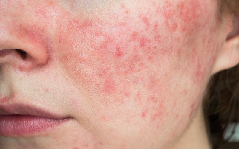 Fatores ambientais e algumas condições podem provocar irritações na pele - iStock