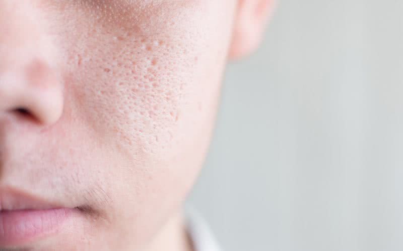 Irritar a pele pode deixar os poros ainda mais visíveis - iStock