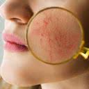 Segundo a Sociedade Brasileira de Dermatologia (SBD), a rosácea atinge de 1,5% a 10% da população - iStock