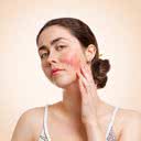 Segundo a Sociedade Brasileira de Dermatologia (SBD), a rosácea atinge de 1,5% a 10% da população - iStock