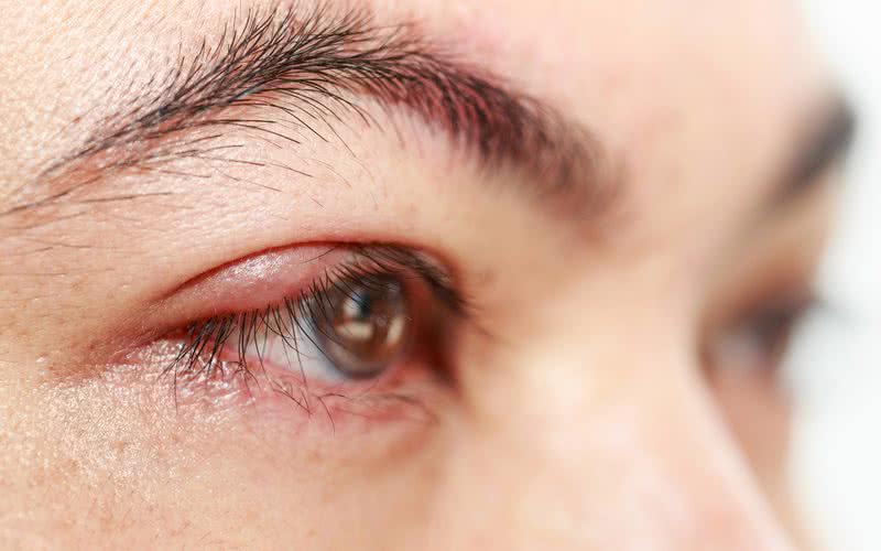 Tocar ou esfregar os olhos é a maneira mais comum de levar as bactérias até a pálpebra - iStock