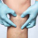 Meses mais frios são os melhores para quem pretender tratar varizes e vasinhos - iStock