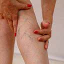 Varizes são vasos venosos de pequeno, médio ou grande porte que se desenvolvem devido à má circulação sanguínea - iStock